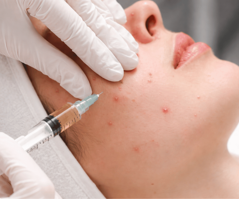 Acne Treatment - Clear & Healthy Skin